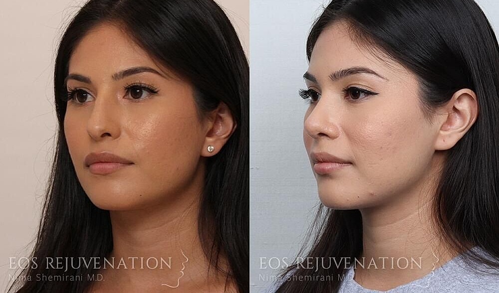 Rhinoplasty Before & After
