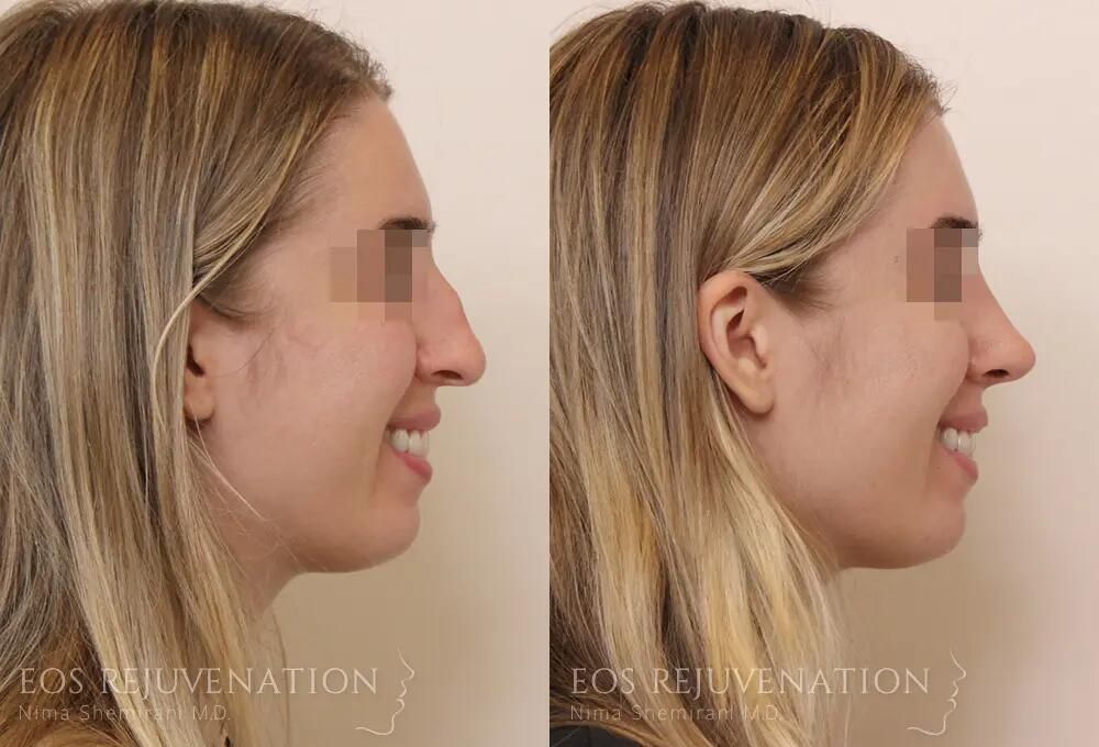 Rhinoplasty Before & After