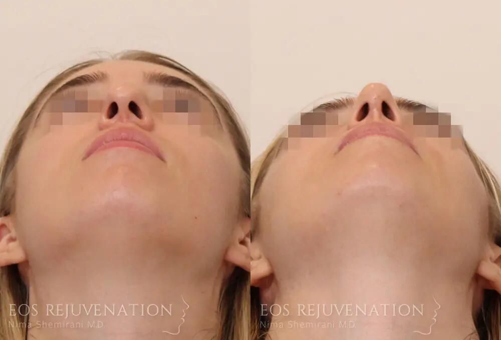 Rhinoplasty Before & After