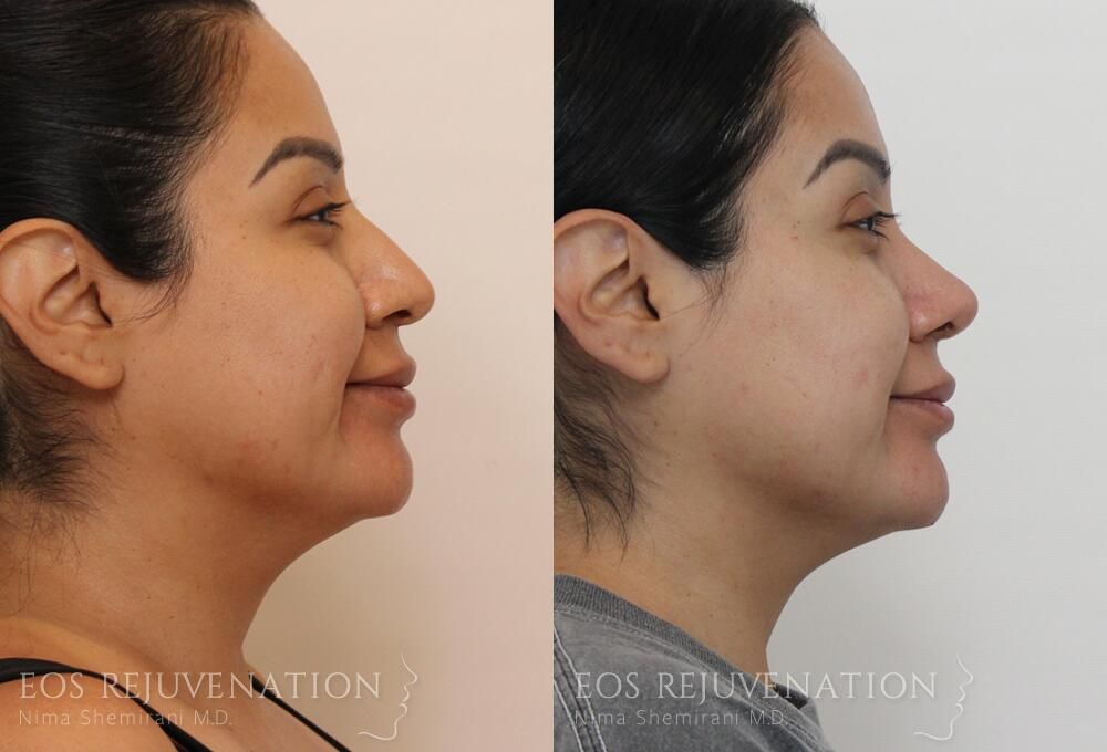 Rhinoplasty Before & After