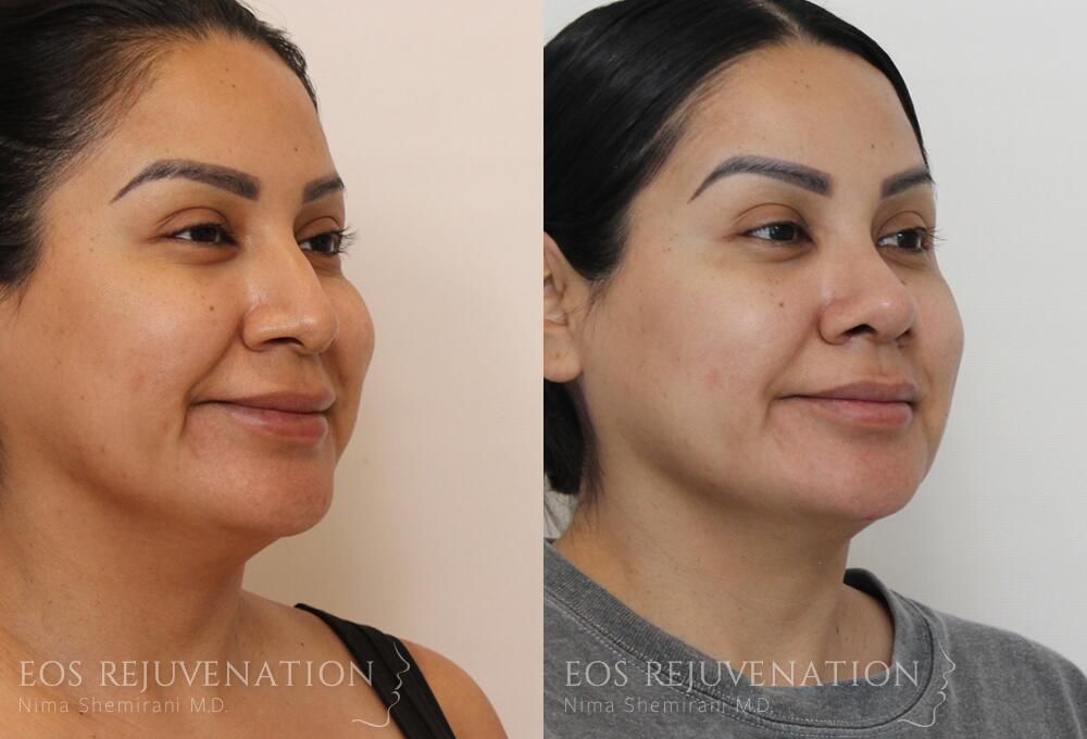 Rhinoplasty Before & After