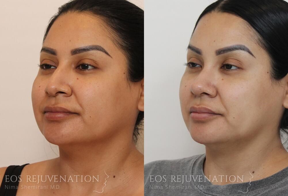 Rhinoplasty Before & After