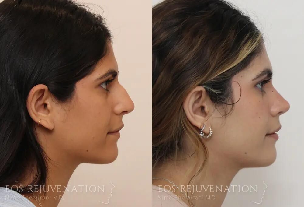 Rhinoplasty Before & After
