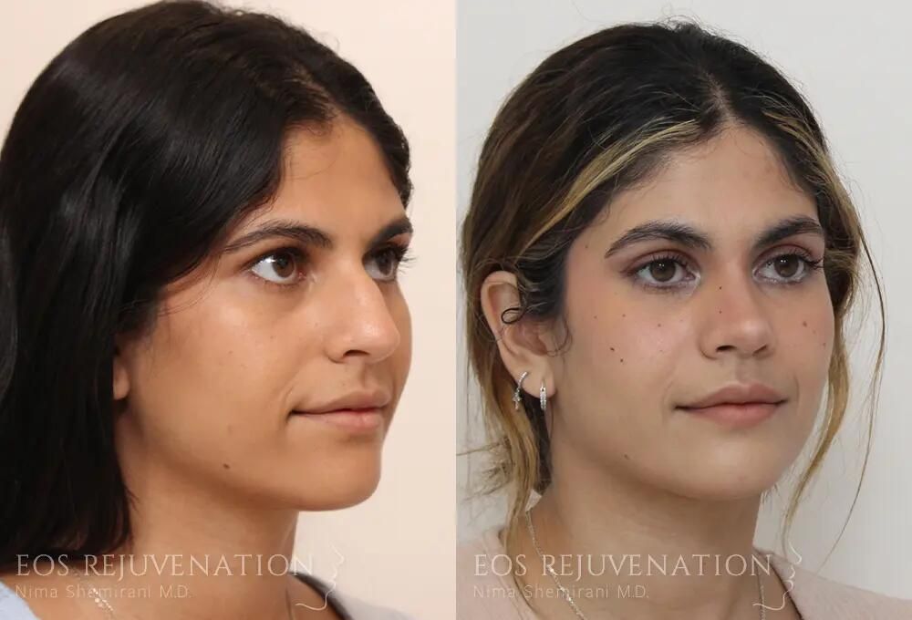 Rhinoplasty Before & After
