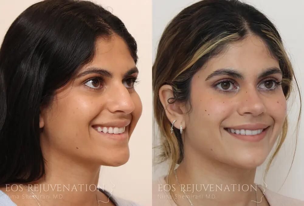 Rhinoplasty Before & After