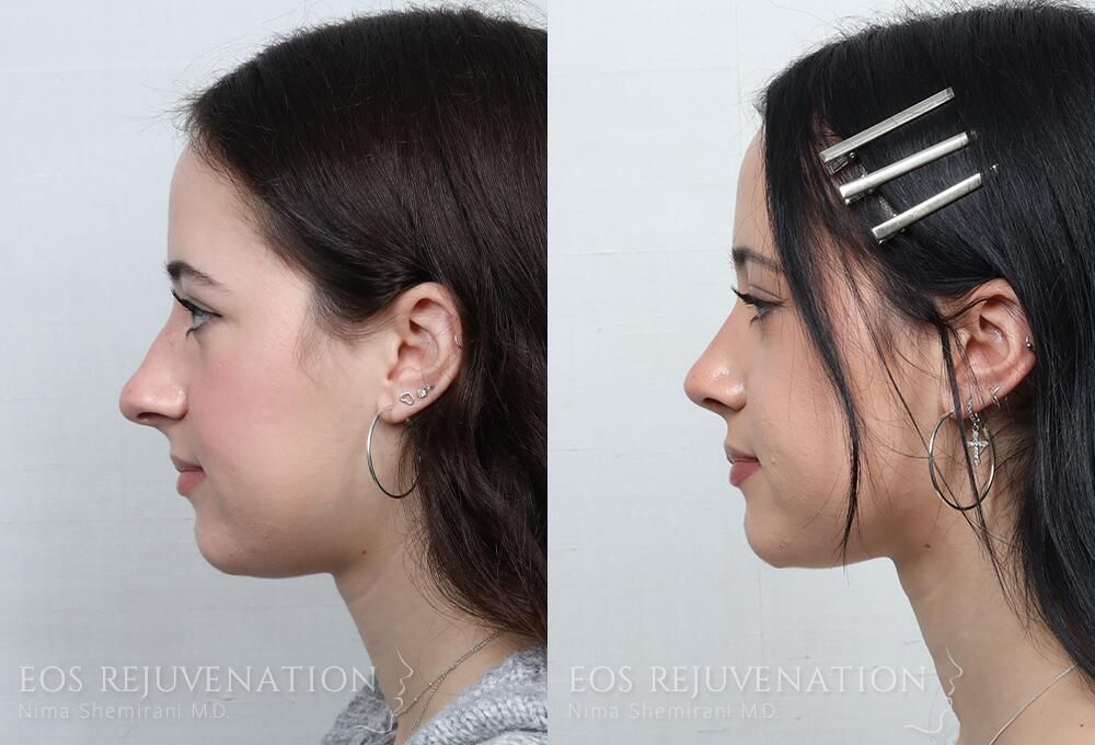 Rhinoplasty Before & After