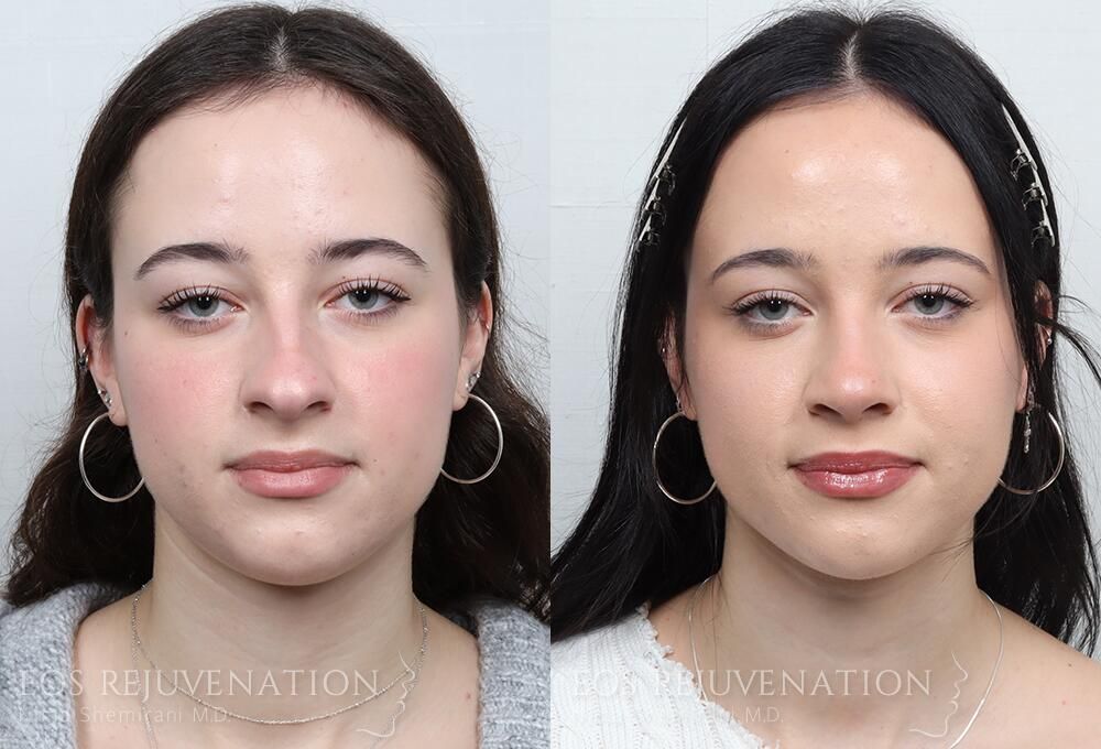 Rhinoplasty Before & After