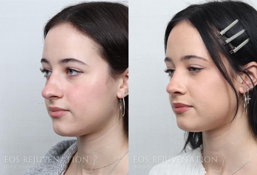 Rhinoplasty Before & After
