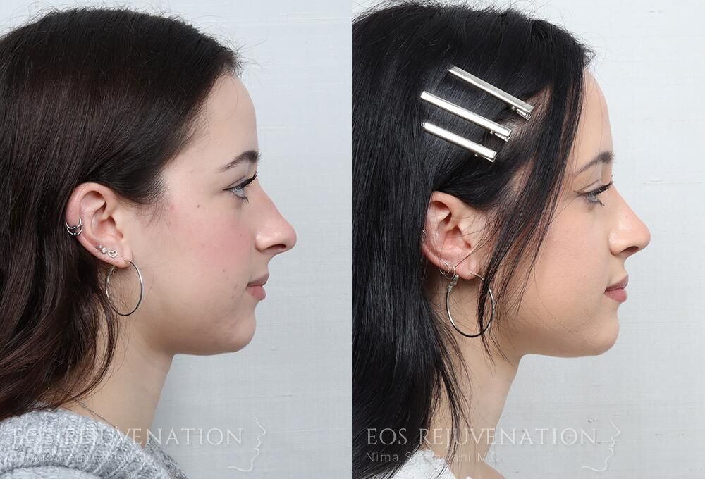 Rhinoplasty Before & After