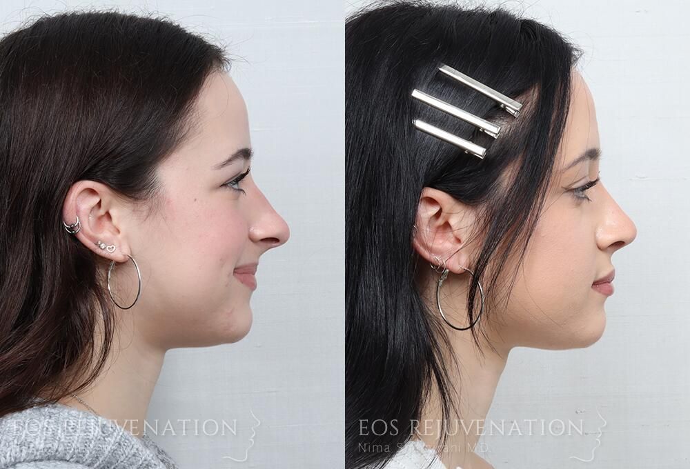Rhinoplasty Before & After