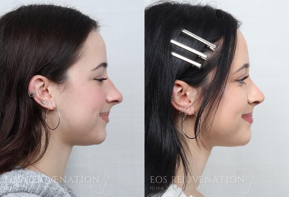 Rhinoplasty Before & After