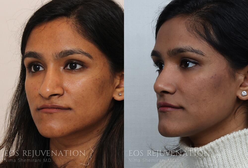 Rhinoplasty Before & After
