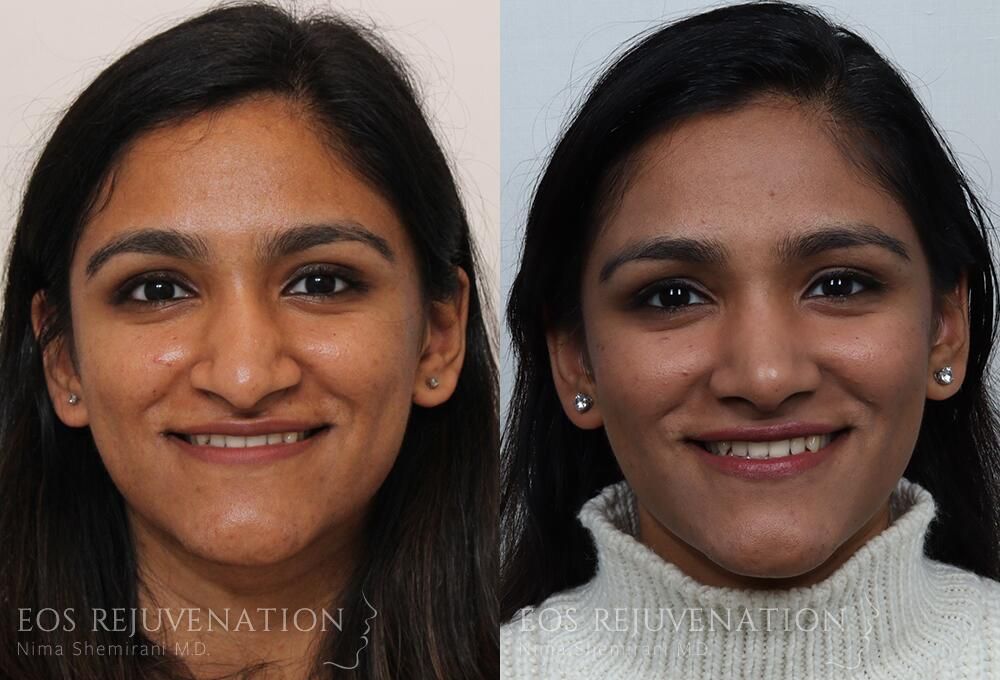 Rhinoplasty Before & After