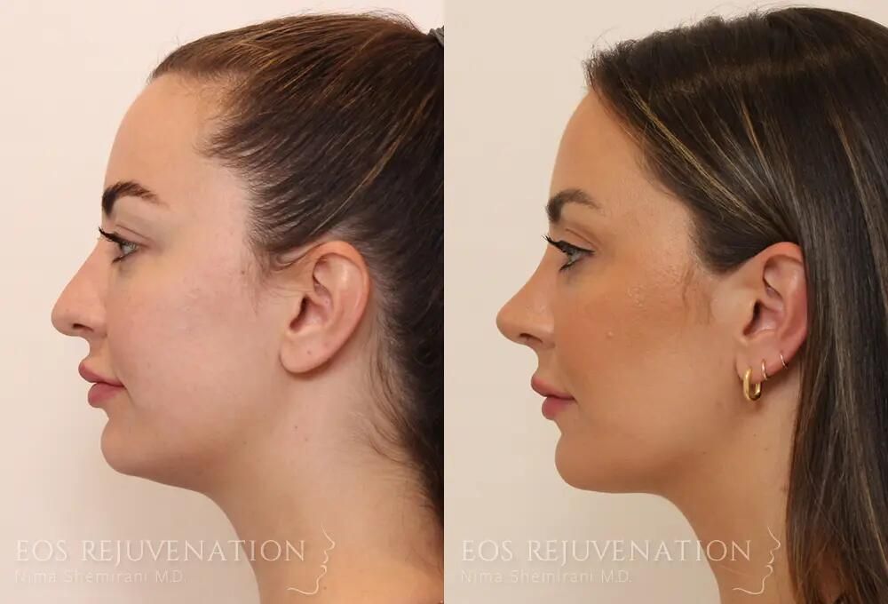 Rhinoplasty Before & After