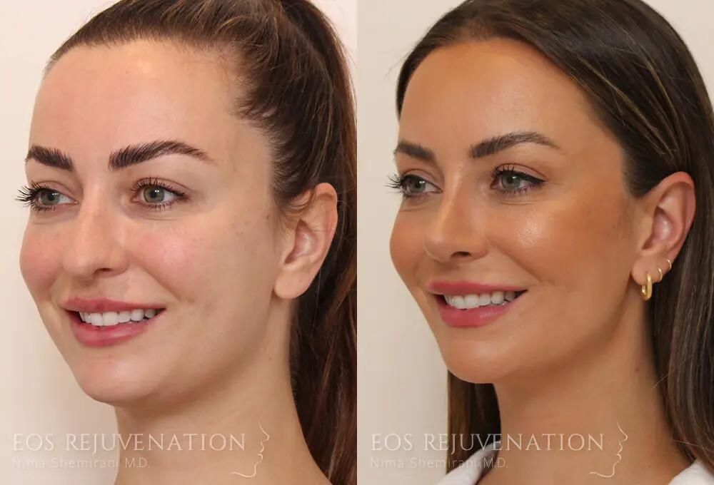 Rhinoplasty Before & After