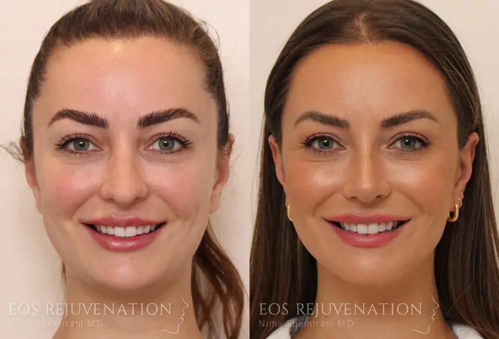 Rhinoplasty Before & After