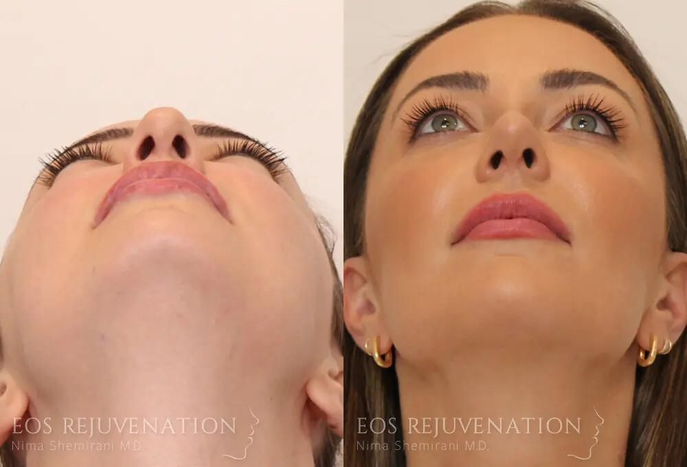 Rhinoplasty Before & After
