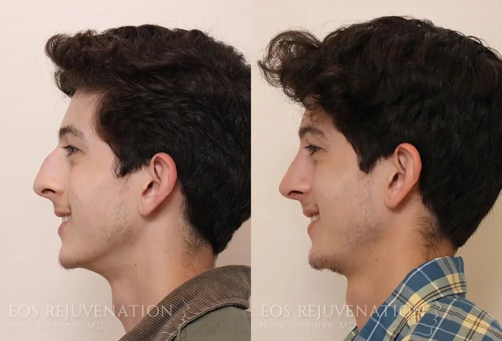 Rhinoplasty Before & After