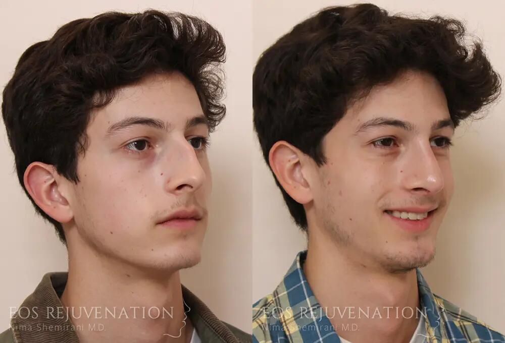Rhinoplasty Before & After