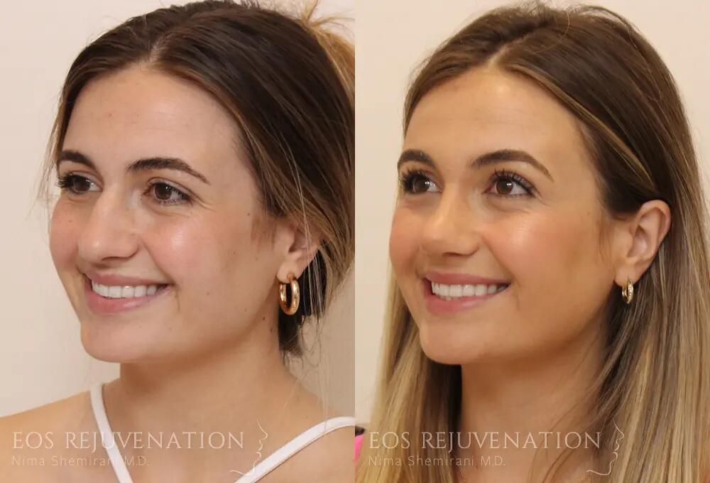 Rhinoplasty Before & After