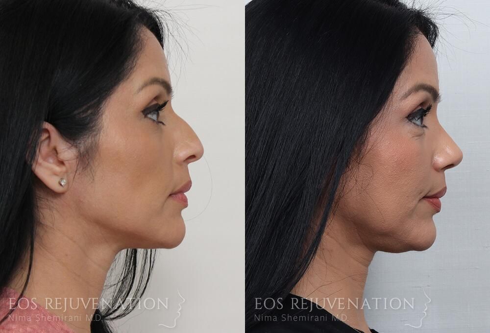 Rhinoplasty Before & After