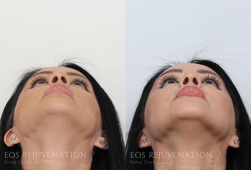 Rhinoplasty Before & After