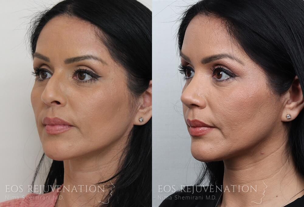 Rhinoplasty Before & After