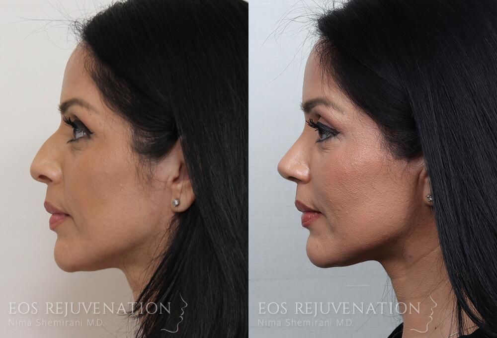 Rhinoplasty Before & After