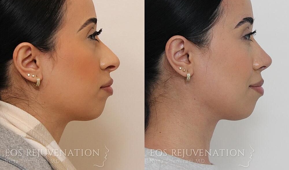 Rhinoplasty Before & After