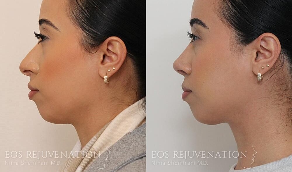 Rhinoplasty Before & After