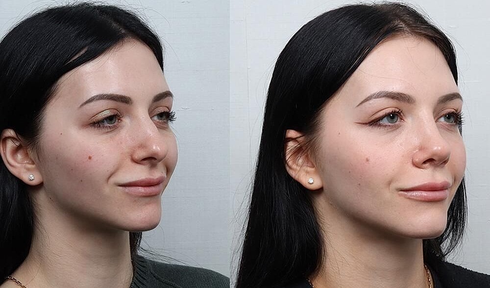 Rhinoplasty Before & After