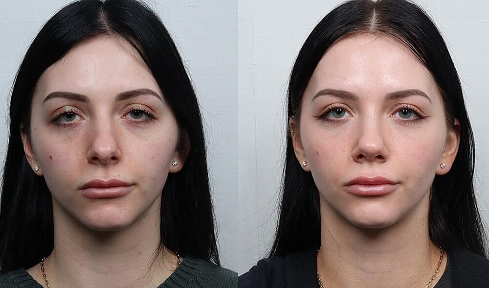 Rhinoplasty Before & After