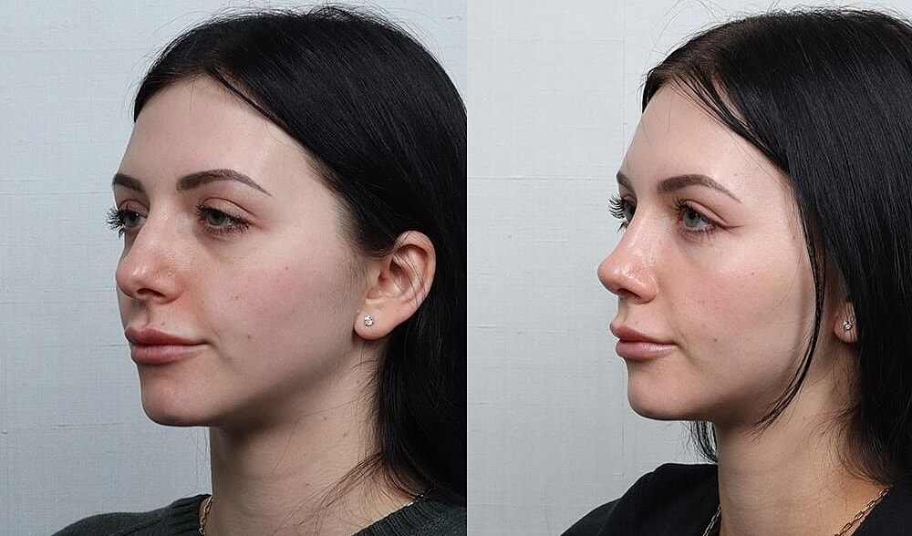 Rhinoplasty Before & After