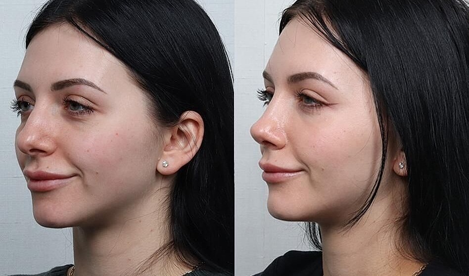 Rhinoplasty Before & After