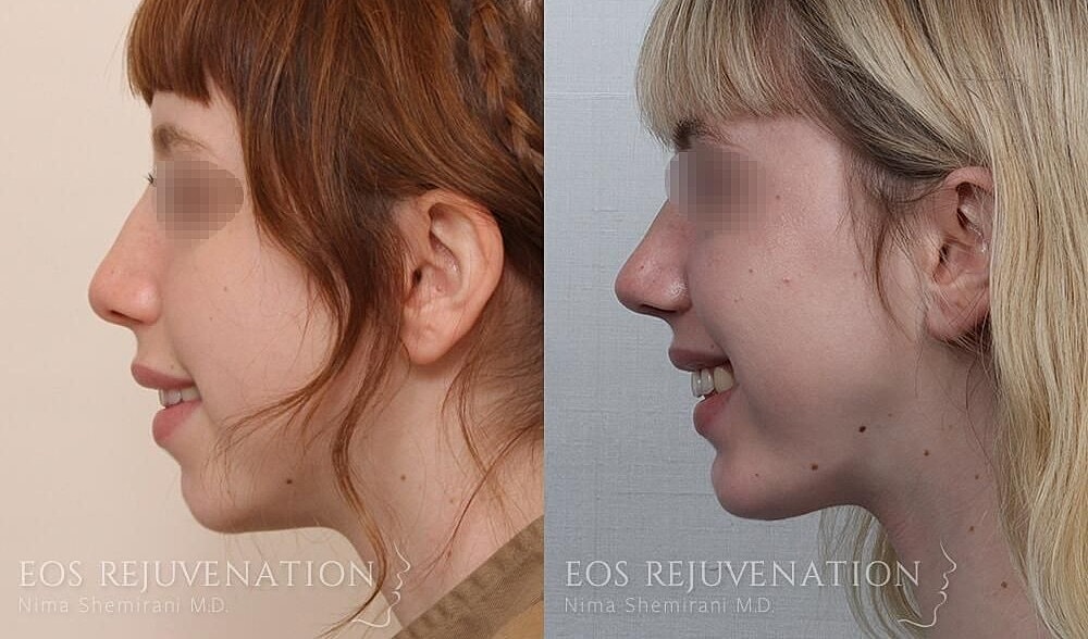 Rhinoplasty Before & After