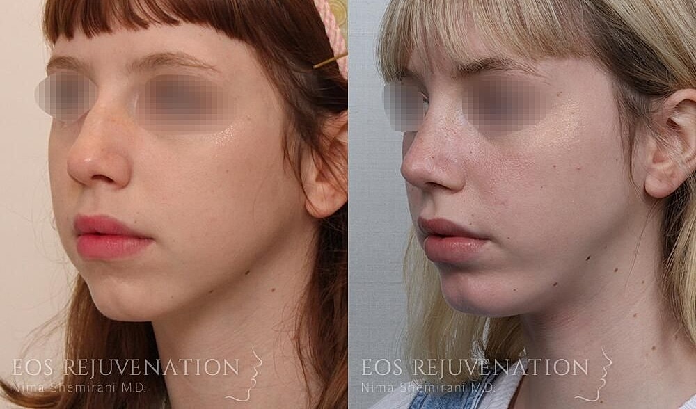 Rhinoplasty Before & After