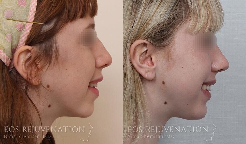 Rhinoplasty Before & After