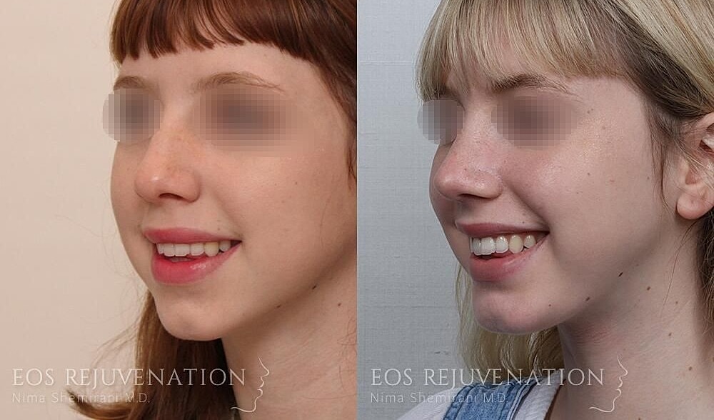 Rhinoplasty Before & After