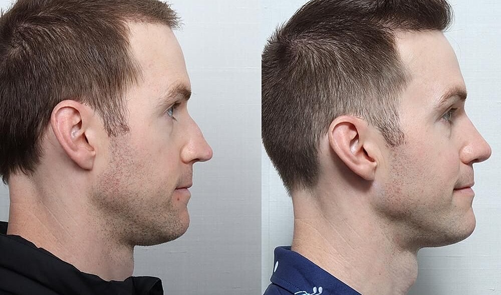 Rhinoplasty Before & After