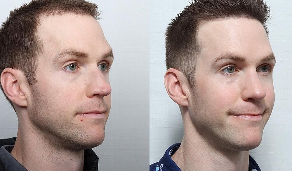 Rhinoplasty Before & After