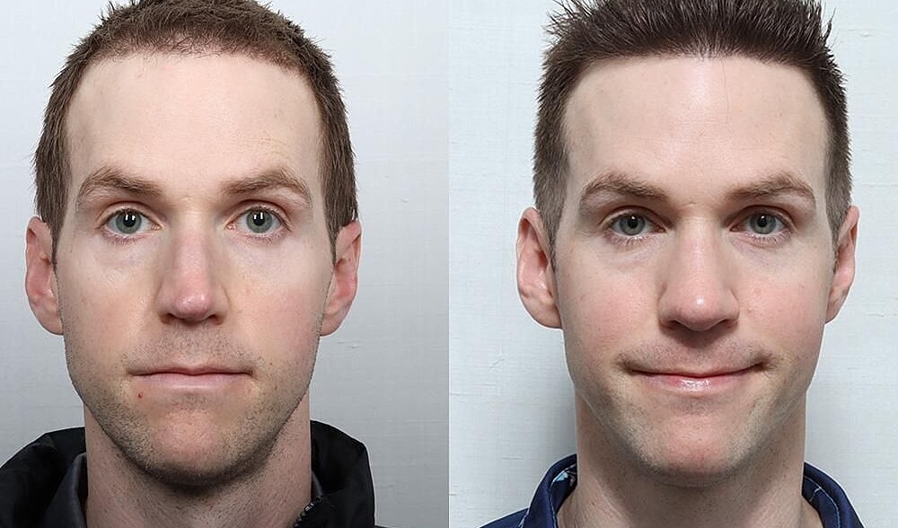 Rhinoplasty Before & After