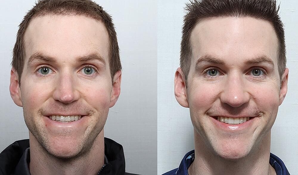 Rhinoplasty Before & After