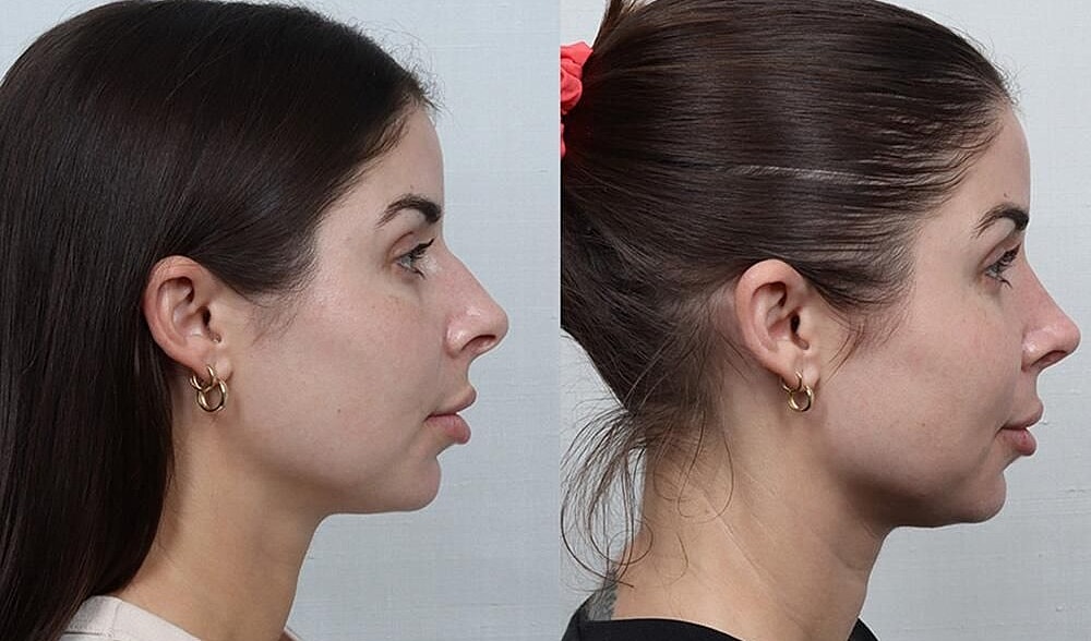 Rhinoplasty Before & After