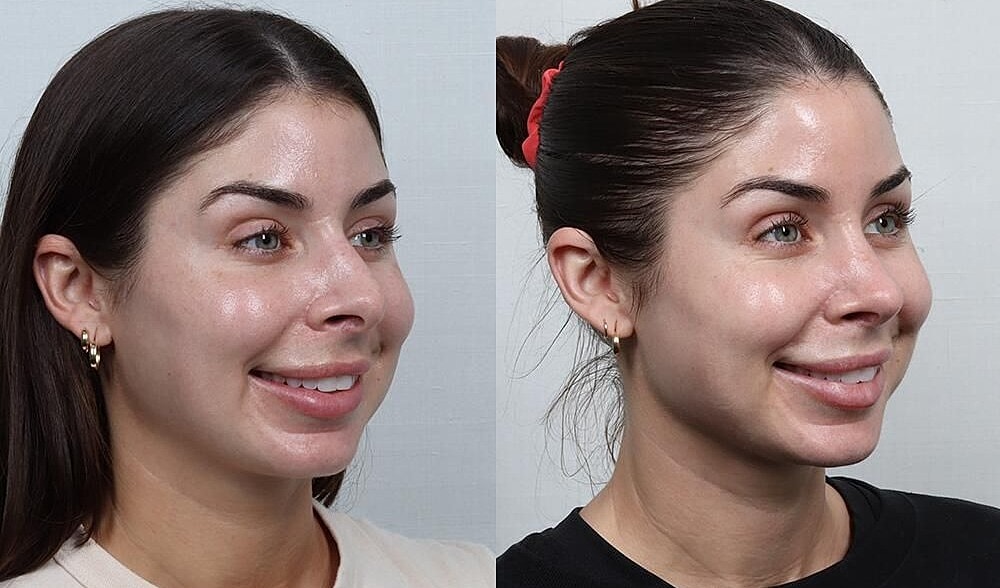 Rhinoplasty Before & After