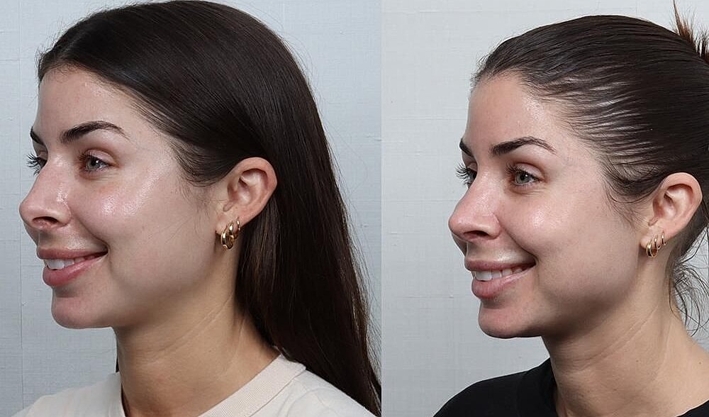 Rhinoplasty Before & After
