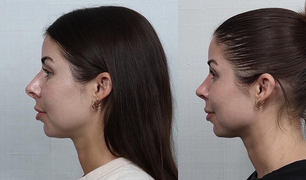 Rhinoplasty Before & After
