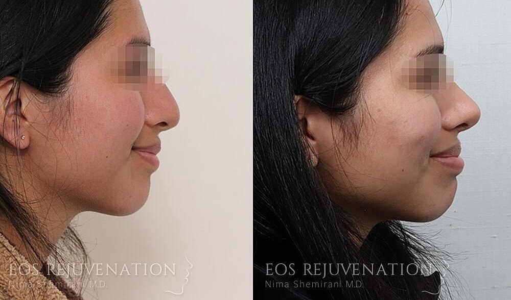 Rhinoplasty Before & After