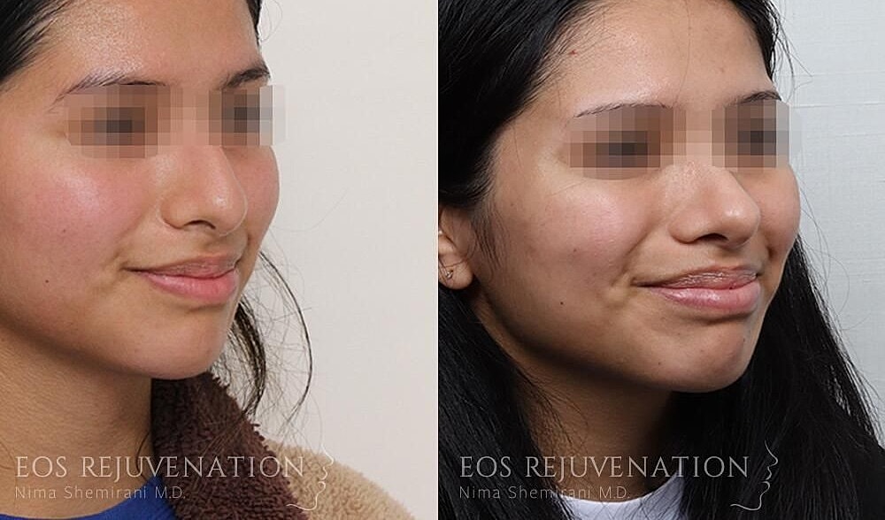 Rhinoplasty Before & After