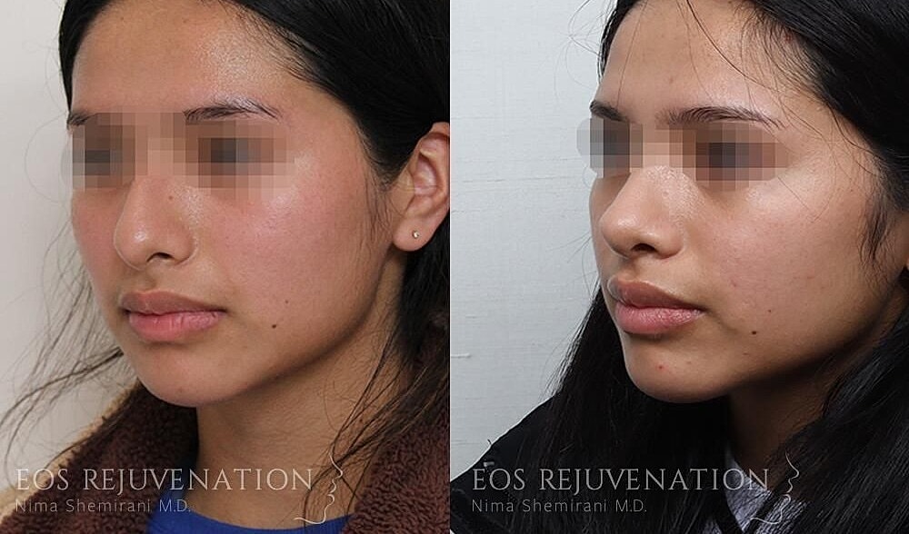 Rhinoplasty Before & After