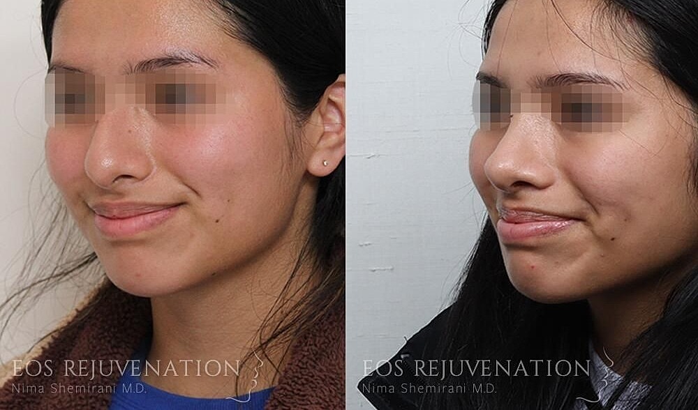 Rhinoplasty Before & After